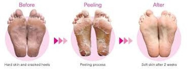 Bathefx Softsole Express Exfoliating Foot Peel